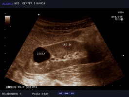 Ultrazvok ledvic - cista na desni ledvici